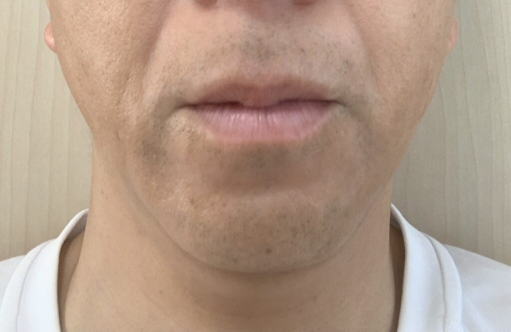 湘南美容外科【SBC】にてヒゲ医療脱も7回目施術後写真