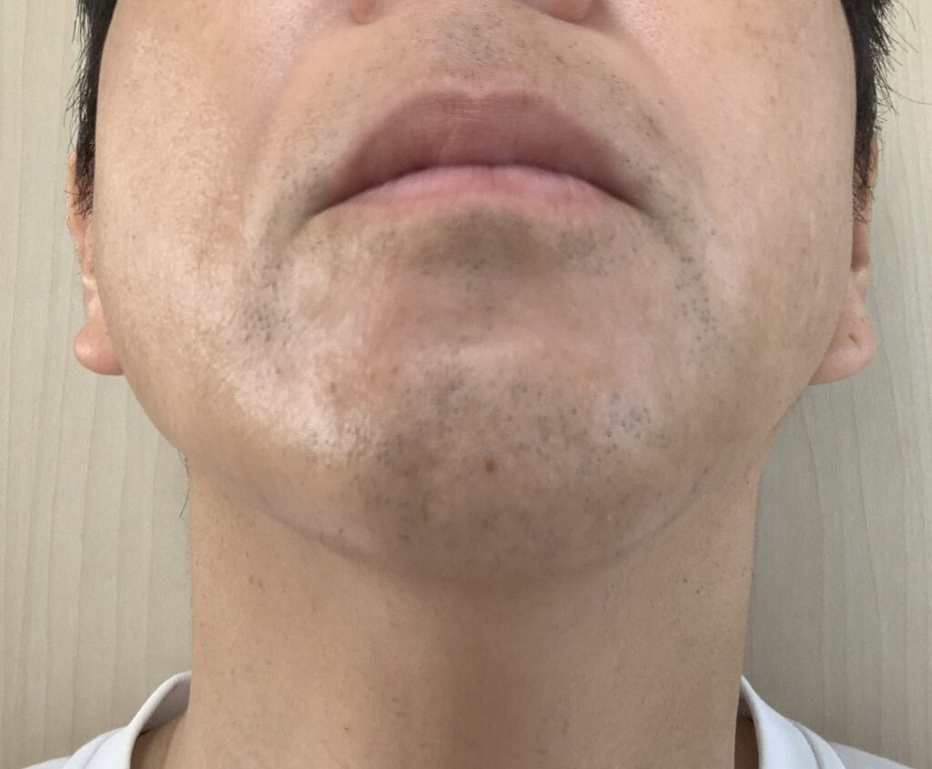 湘南美容外科【SBC】にてヒゲ医療脱も7回目施術後写真