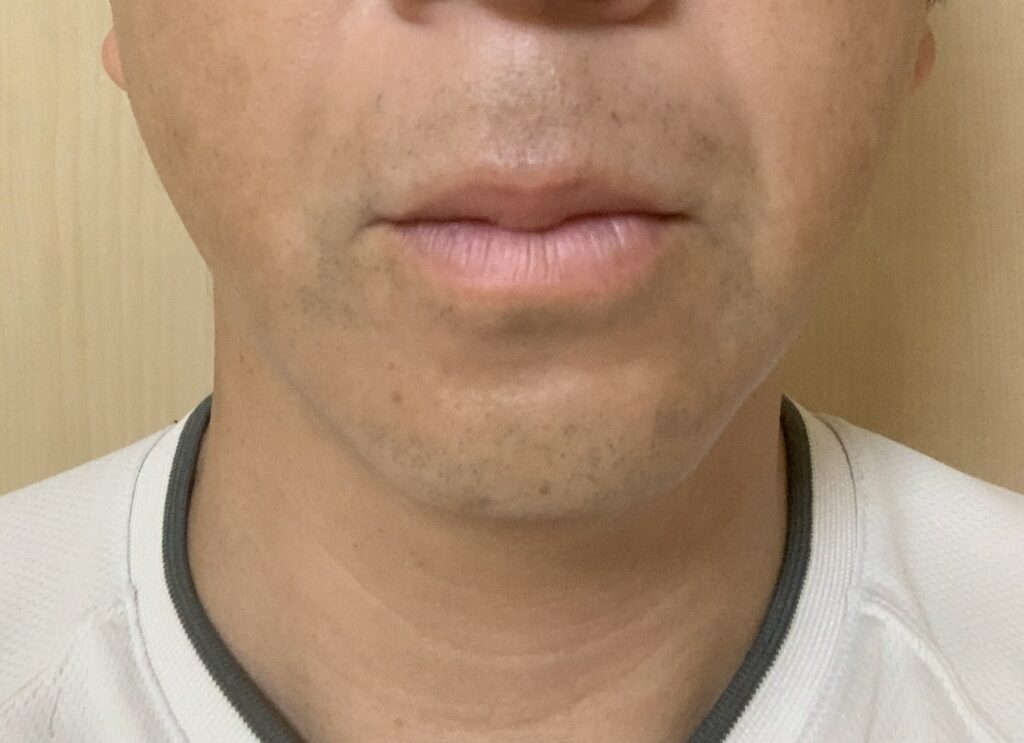 湘南美容外科【SBC】にてヒゲ医療脱も8回目施術前写真