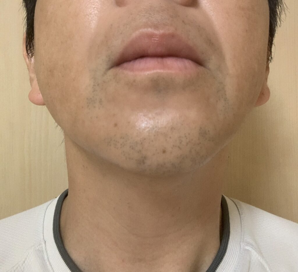 湘南美容外科【SBC】にてヒゲ医療脱も8回目施術前写真