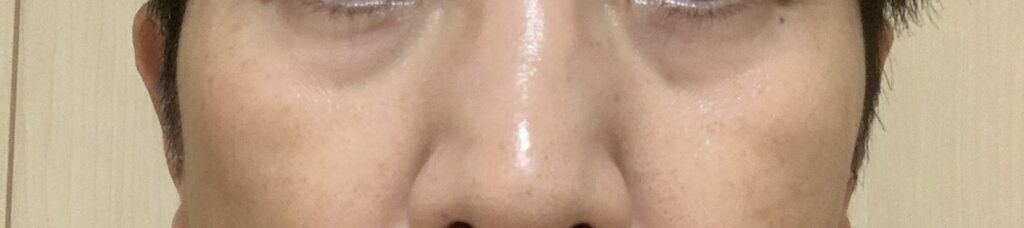 湘南美容外科【SBC】にてリジュランi1回目施術前写真