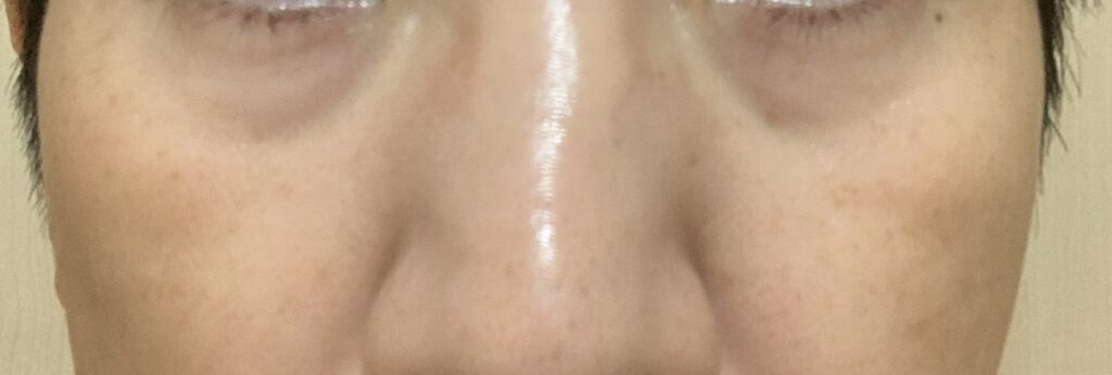湘南美容外科【SBC】にてリジュランi1回目施術前写真